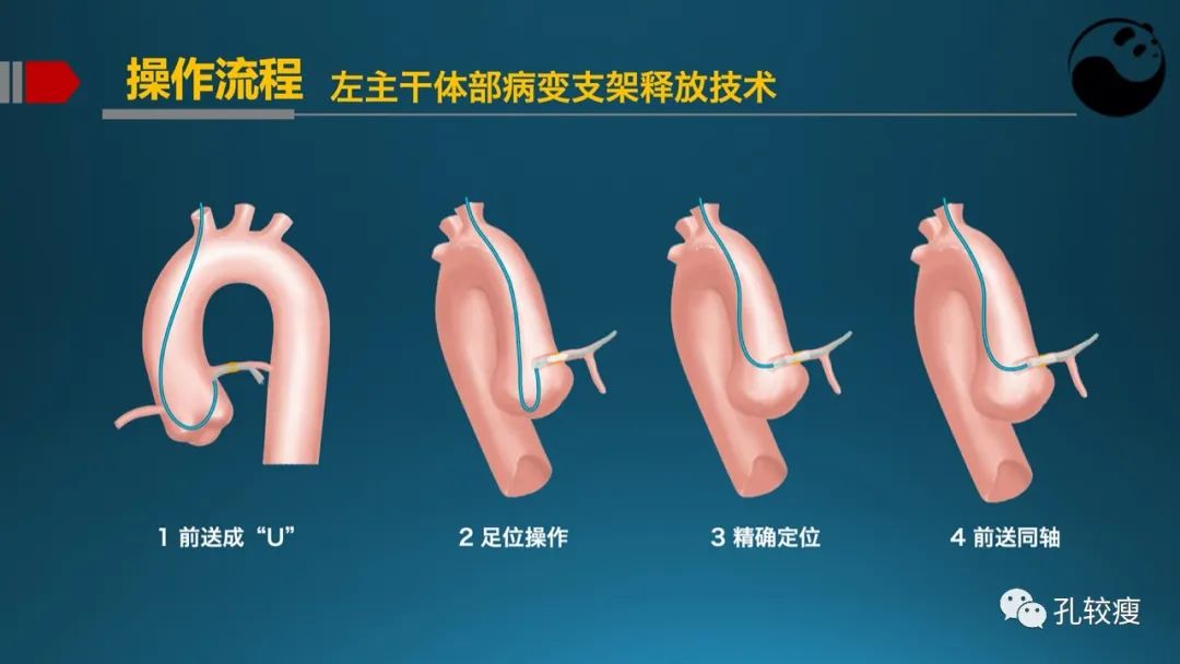 左主干指引导管的选择