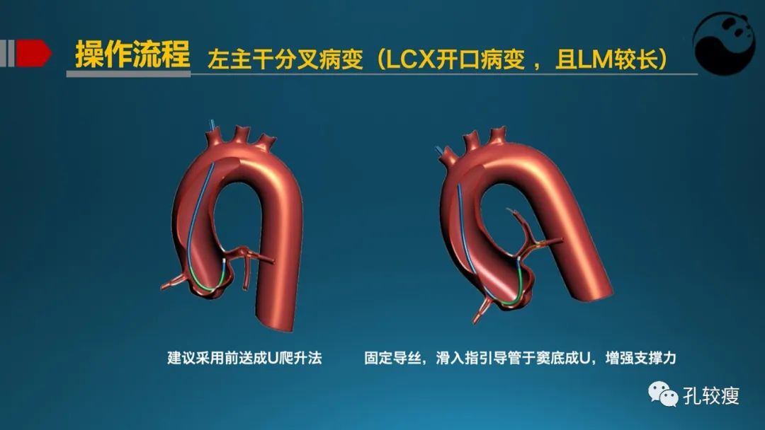 左主干指引导管的选择