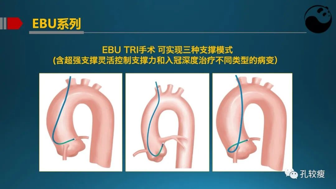 左主干指引导管的选择