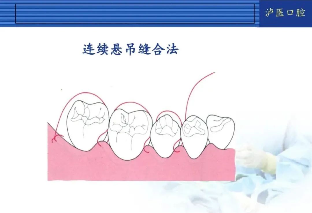 翻瓣手术如何做,看完这篇手术思路更清晰!