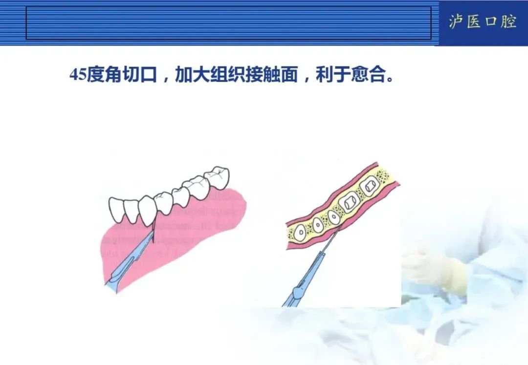 翻瓣手术如何做,看完这篇手术思路更清晰!