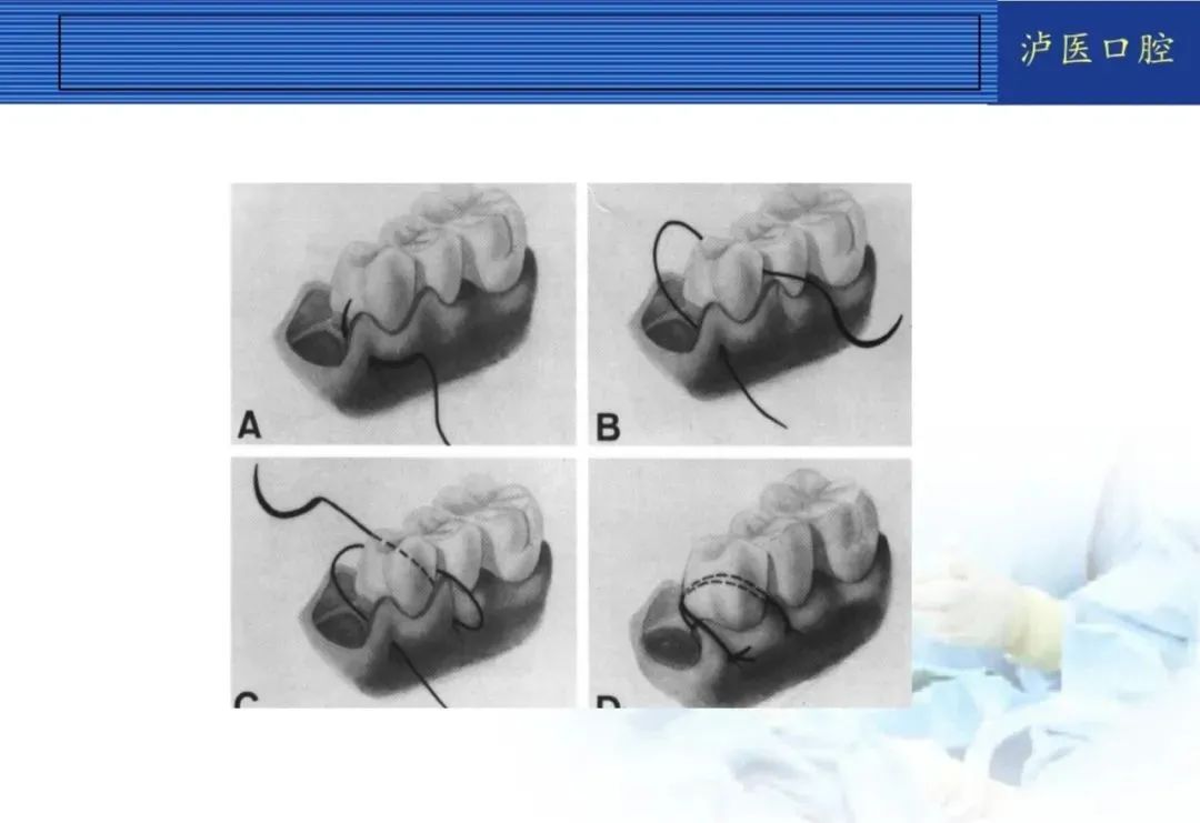 翻瓣手术如何做,看完这篇手术思路更清晰!