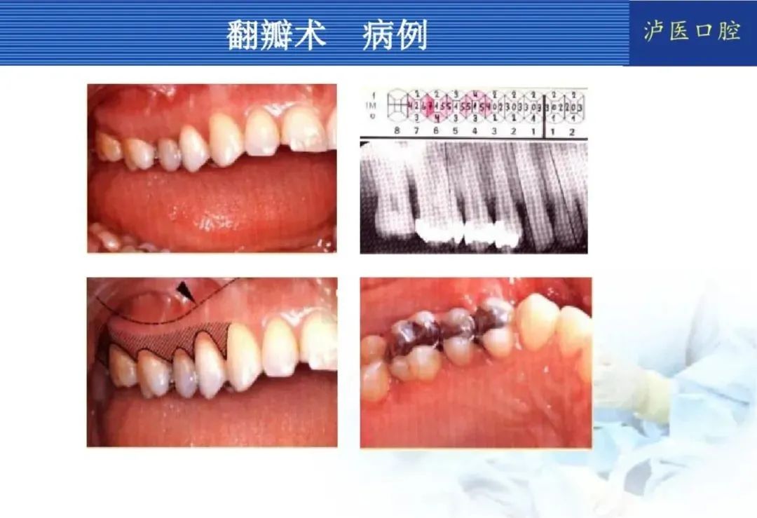 翻瓣手术如何做,看完这篇手术思路更清晰!