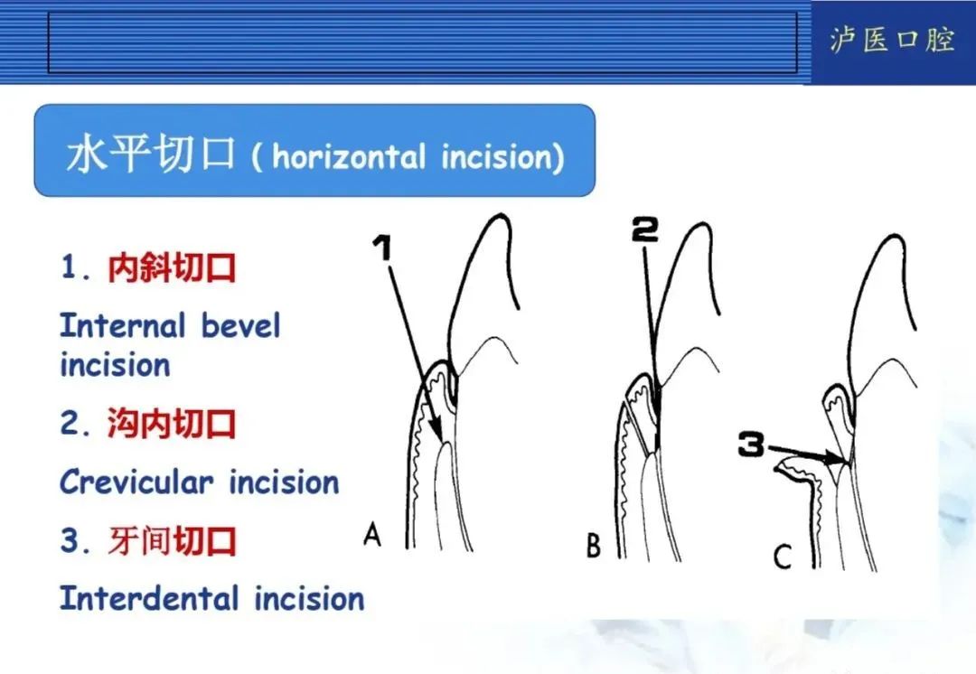 翻瓣手术如何做,看完这篇手术思路更清晰!