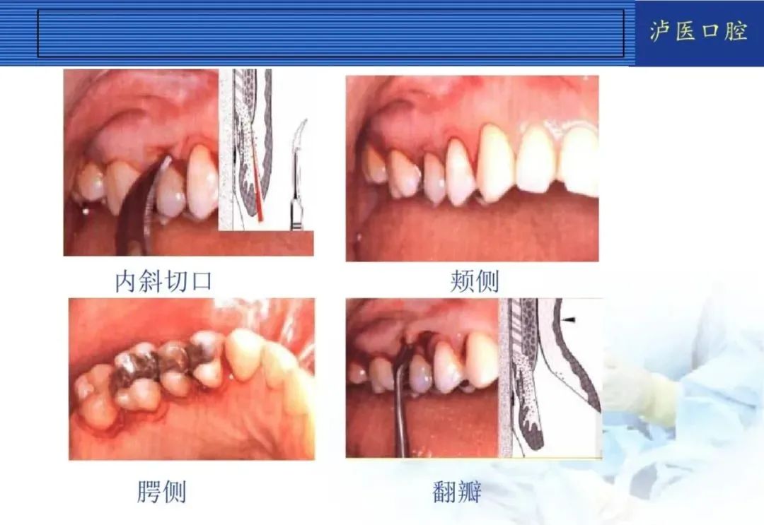 翻瓣手术如何做,看完这篇手术思路更清晰!
