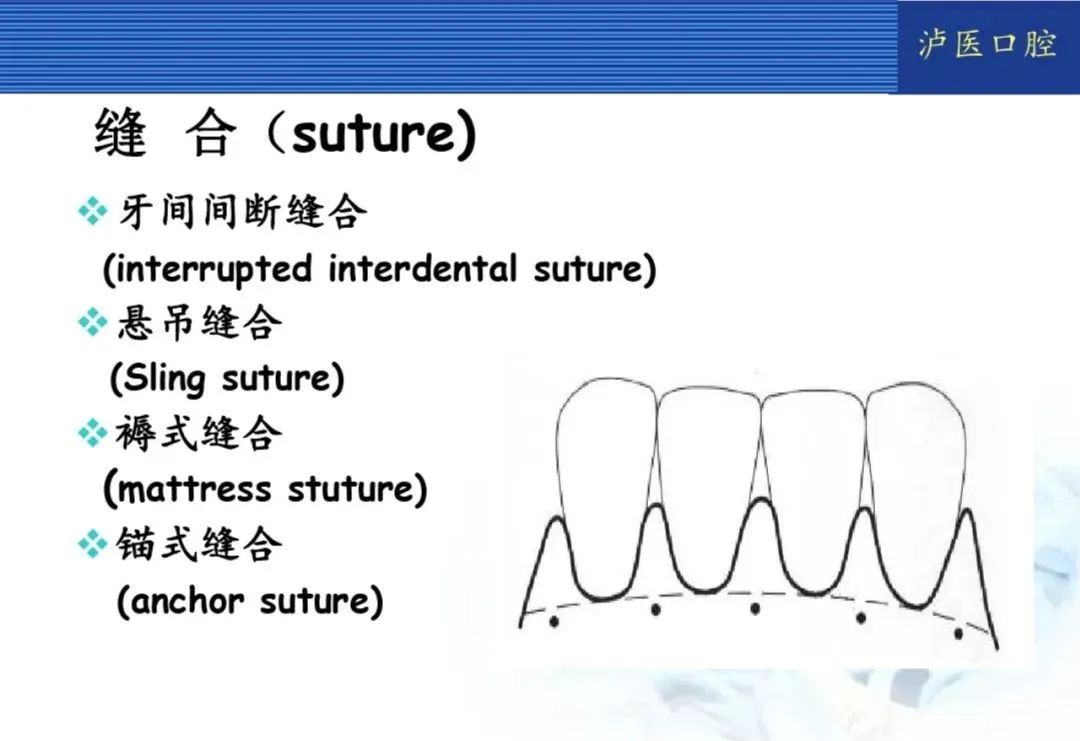 翻瓣手术如何做,看完这篇手术思路更清晰!