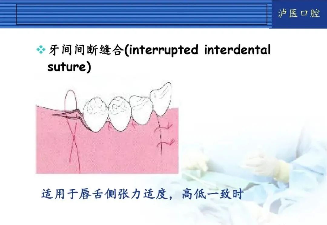 翻瓣手术如何做,看完这篇手术思路更清晰!