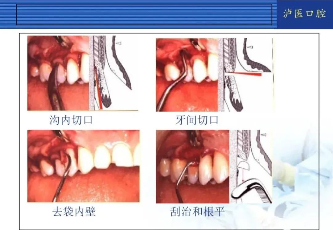翻瓣手术如何做,看完这篇手术思路更清晰!