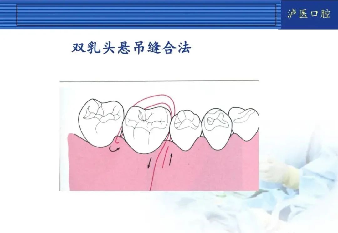 翻瓣手术如何做,看完这篇手术思路更清晰!
