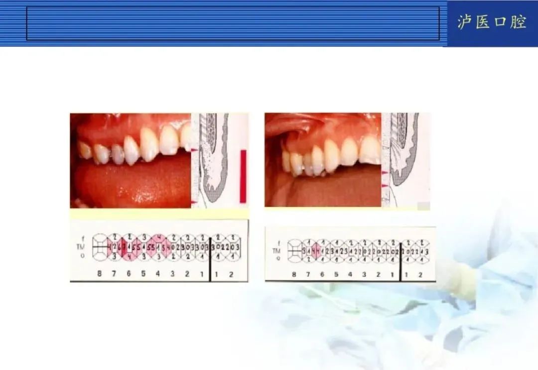 翻瓣手术如何做,看完这篇手术思路更清晰!