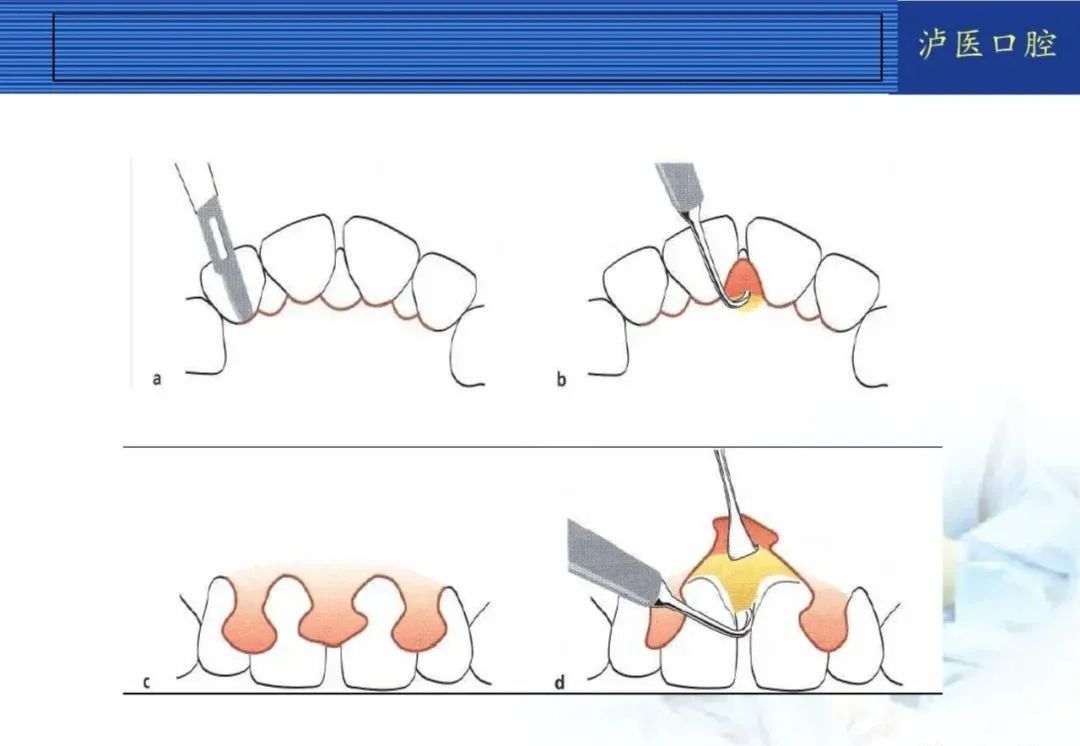 翻瓣手术如何做,看完这篇手术思路更清晰!