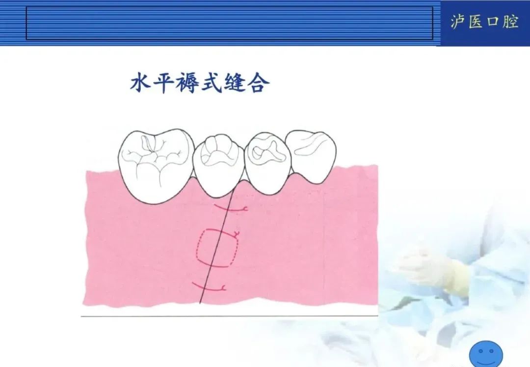 翻瓣手术如何做,看完这篇手术思路更清晰!