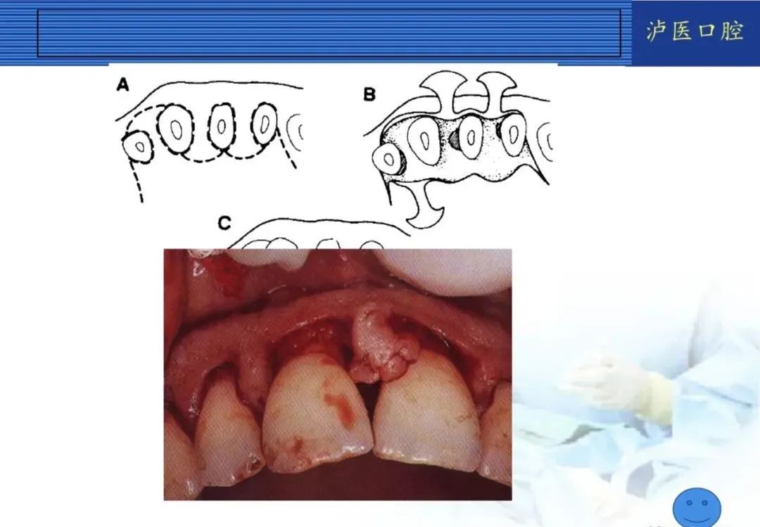 翻瓣手术如何做,看完这篇手术思路更清晰!