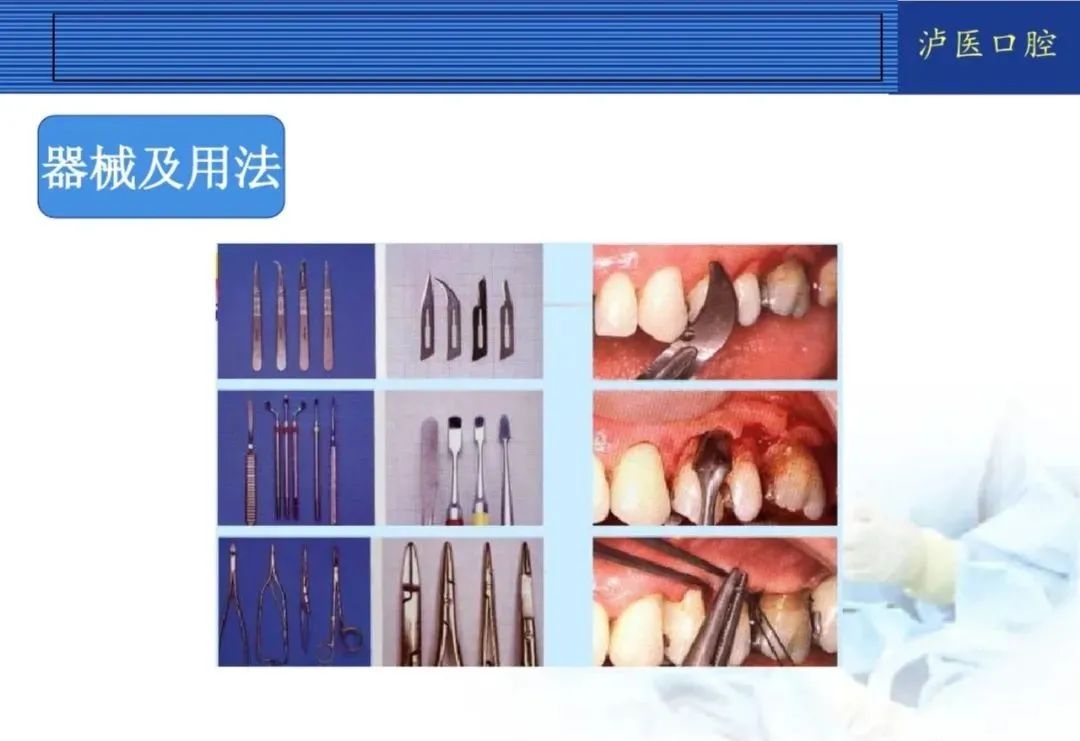 翻瓣手术如何做,看完这篇手术思路更清晰!