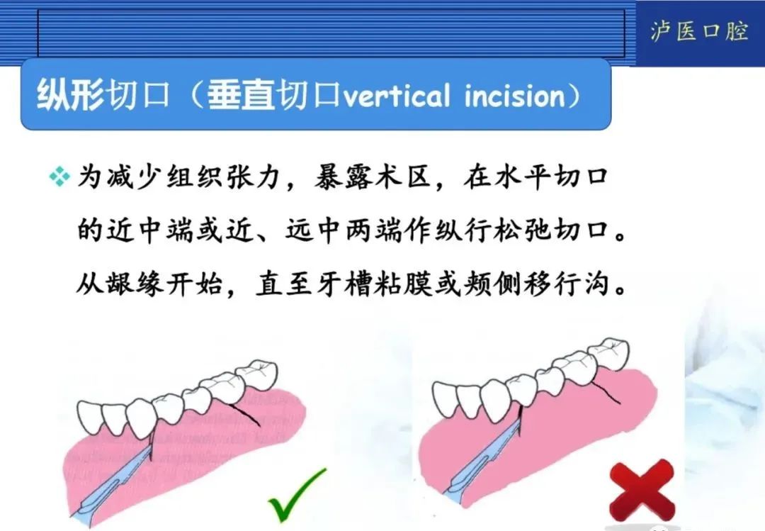 翻瓣手术如何做,看完这篇手术思路更清晰!