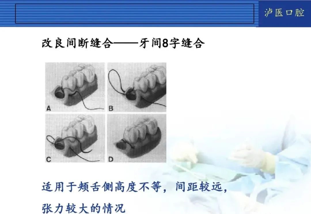 翻瓣手术如何做,看完这篇手术思路更清晰!