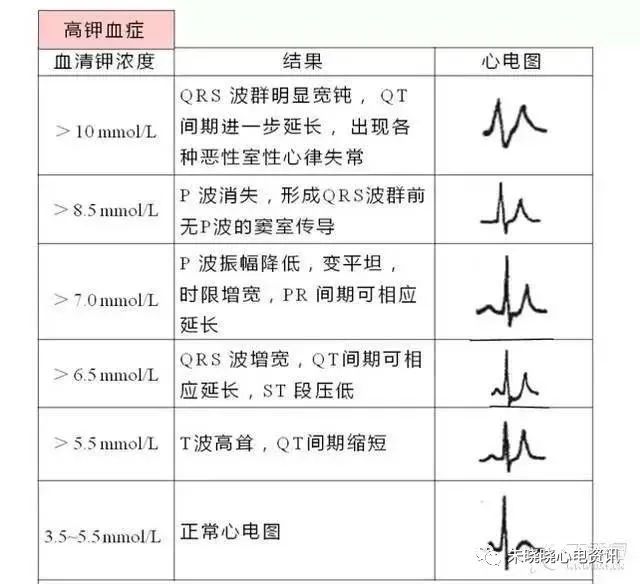 T波高尖，可能会是哪些疾病？