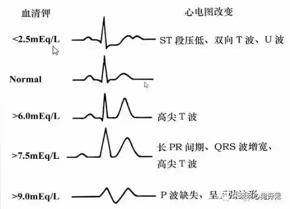 T波高尖，可能会是哪些疾病？