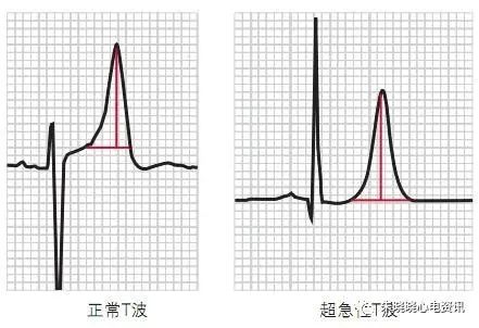 T波高尖，可能会是哪些疾病？