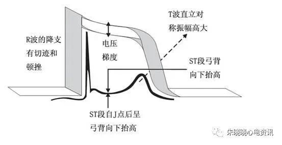 T波高尖，可能会是哪些疾病？