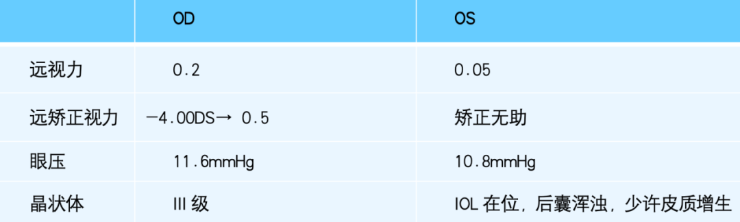病历分享丨单眼LASIK术后白内障