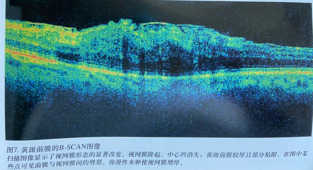 常见OCT影像及图像解读