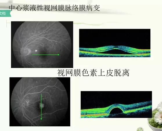 常见OCT影像及图像解读