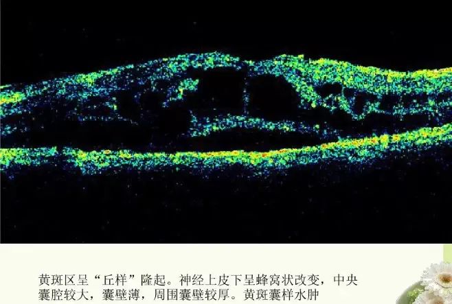 常见OCT影像及图像解读