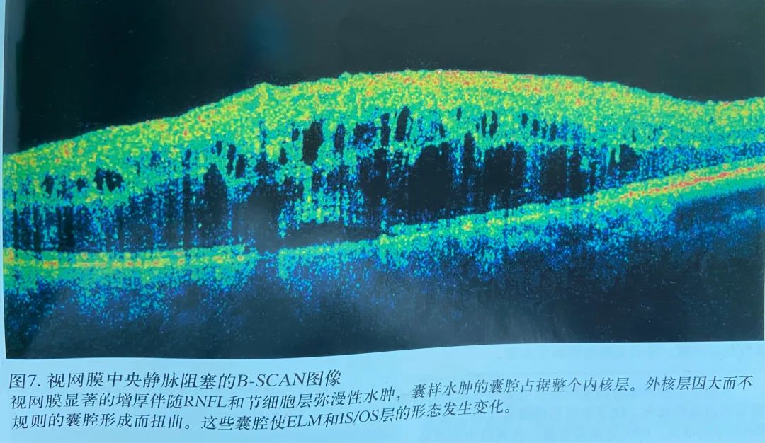 常见OCT影像及图像解读