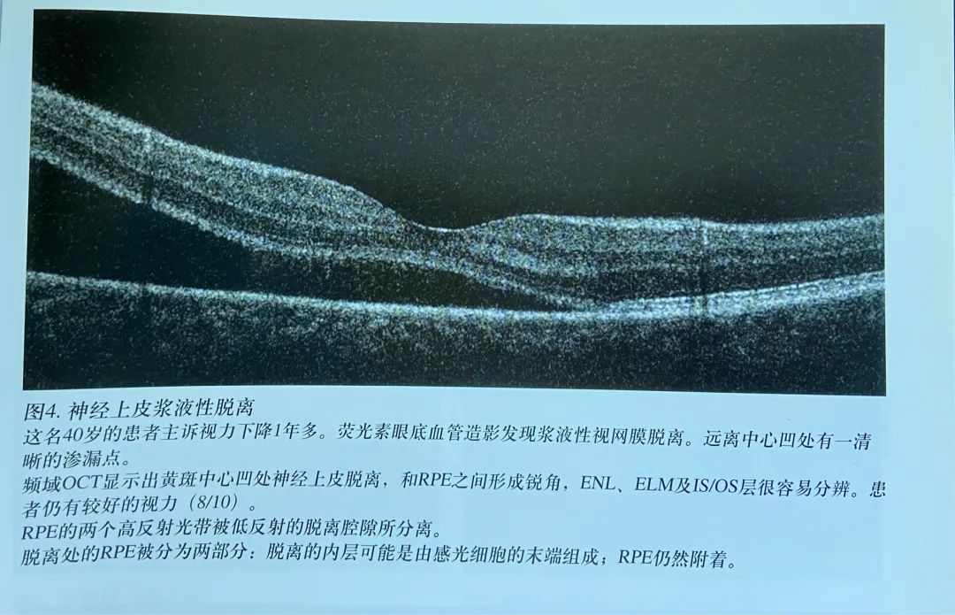 常见OCT影像及图像解读