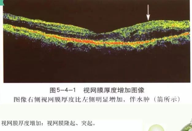常见OCT影像及图像解读