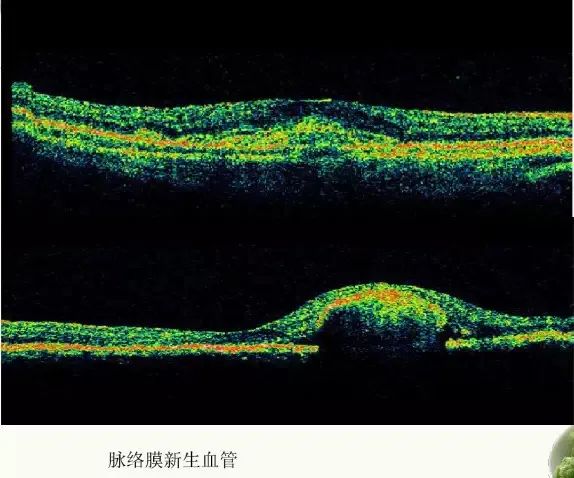 常见OCT影像及图像解读