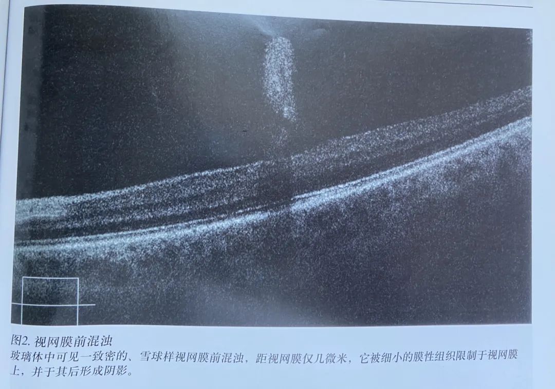 常见OCT影像及图像解读
