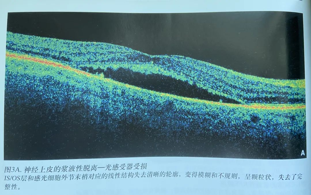 常见OCT影像及图像解读