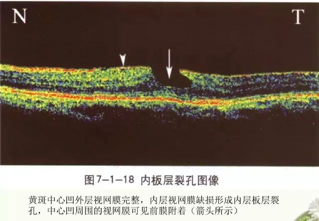 常见OCT影像及图像解读