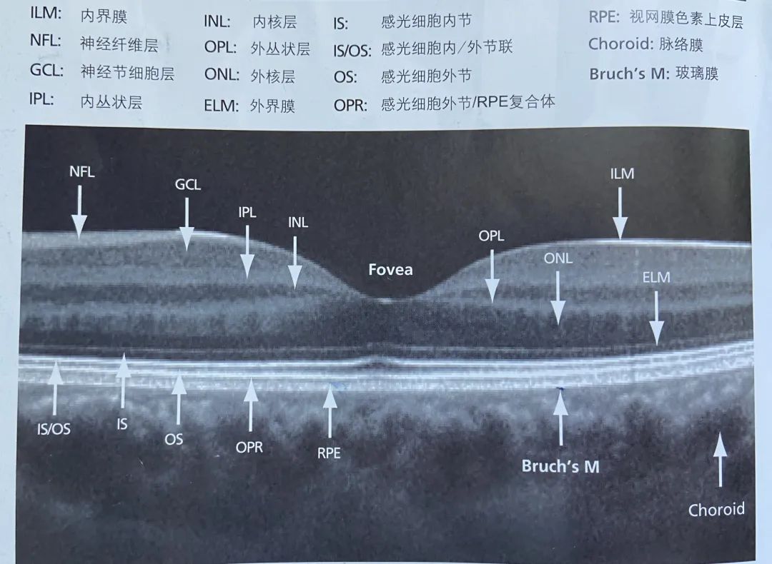 常见OCT影像及图像解读