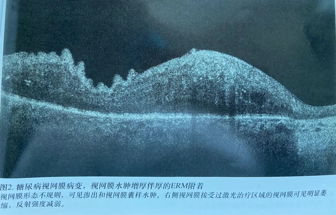 常见OCT影像及图像解读