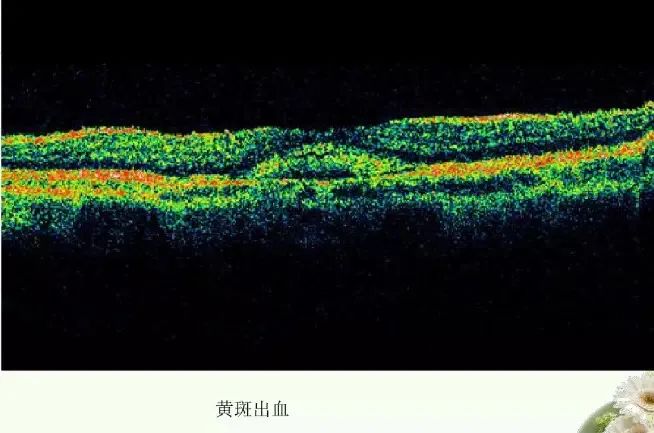 常见OCT影像及图像解读