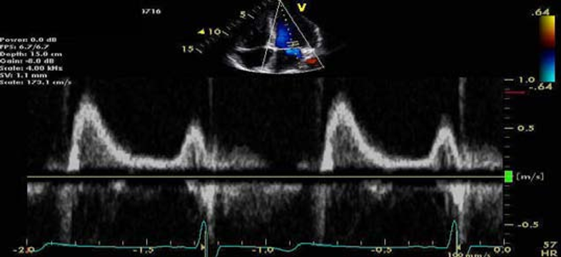 E/e'测量时，e'测值取二尖瓣环侧壁还是间隔侧？