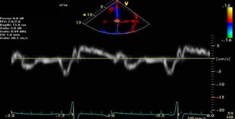 E/e'测量时，e'测值取二尖瓣环侧壁还是间隔侧？