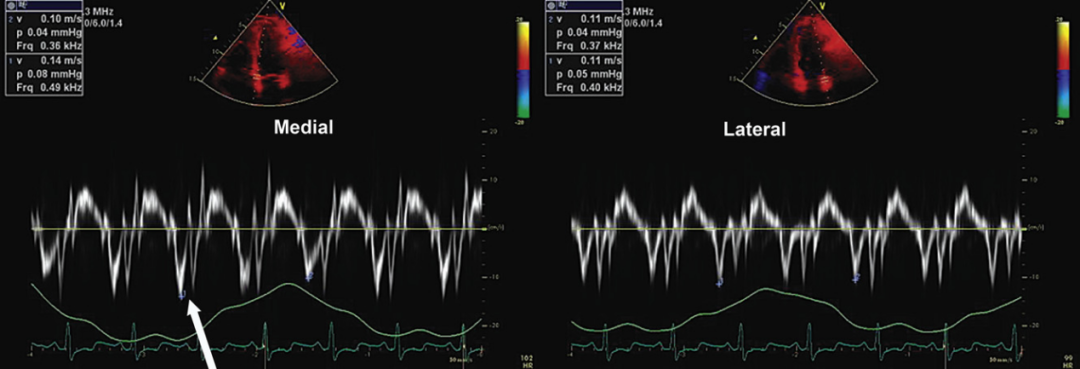 E/e'测量时，e'测值取二尖瓣环侧壁还是间隔侧？