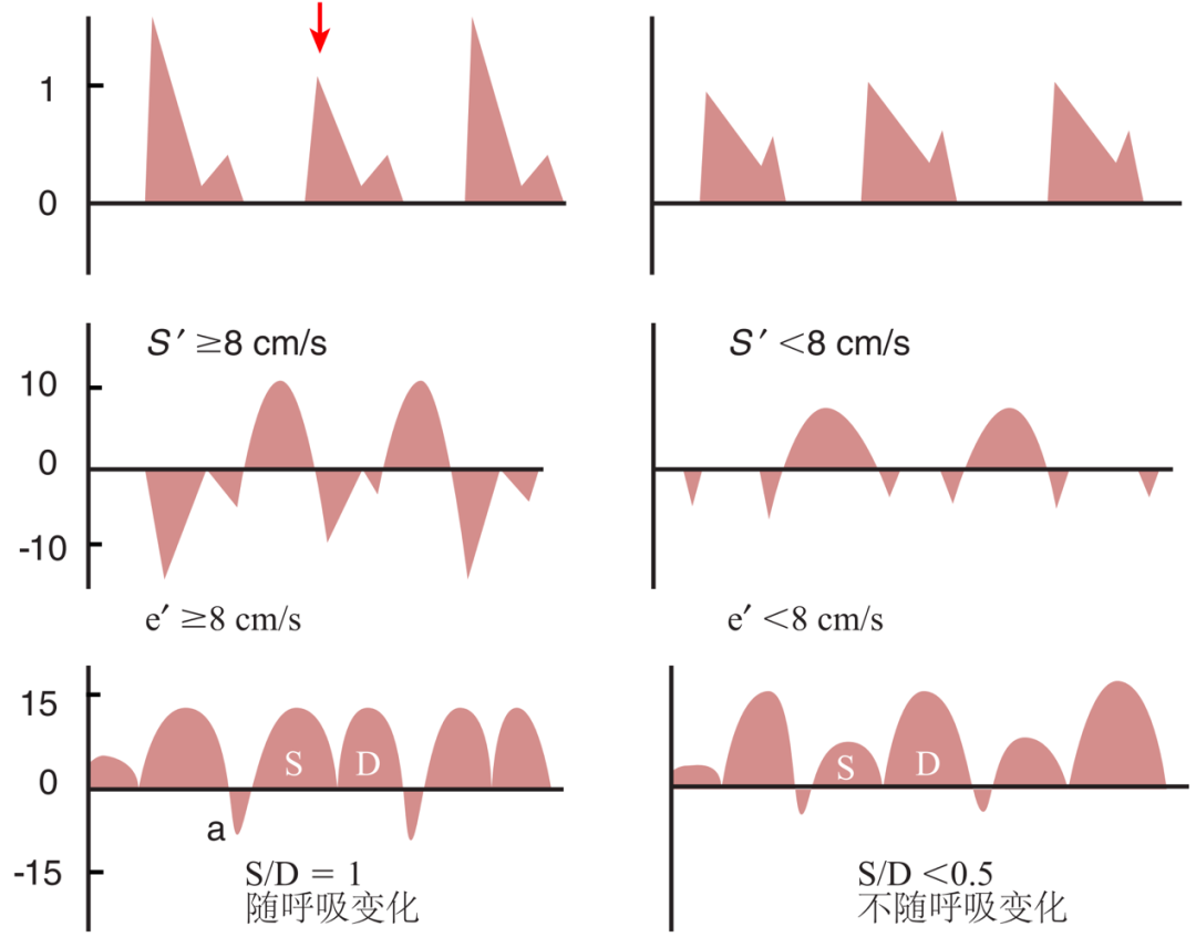 E/e'测量时，e'测值取二尖瓣环侧壁还是间隔侧？
