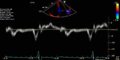 E/e'测量时，e'测值取二尖瓣环侧壁还是间隔侧？