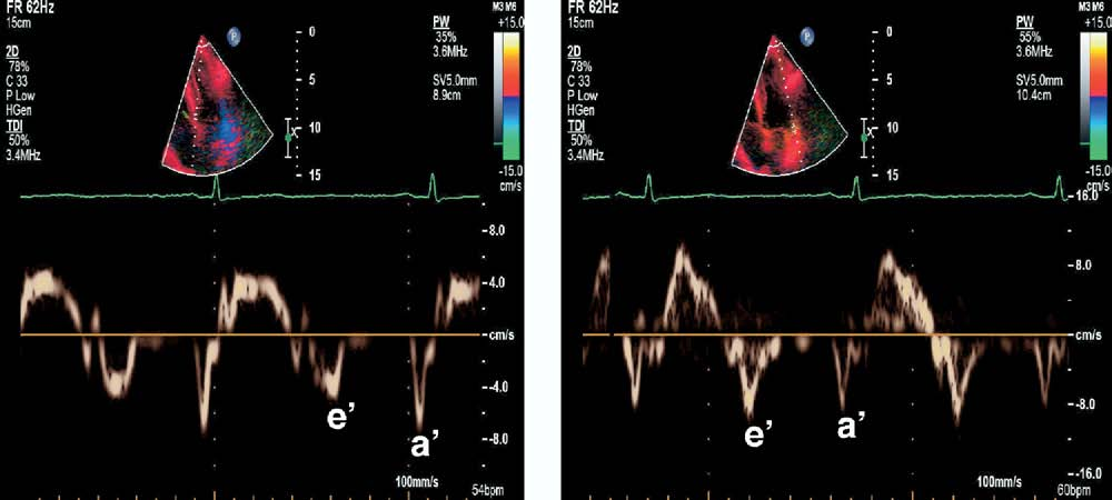 E/e'测量时，e'测值取二尖瓣环侧壁还是间隔侧？