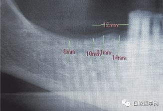忘调转速,植体撕裂神经