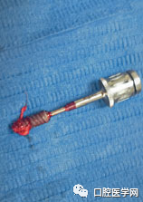 忘调转速,植体撕裂神经