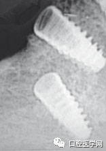 忘调转速,植体撕裂神经