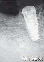 忘调转速,植体撕裂神经