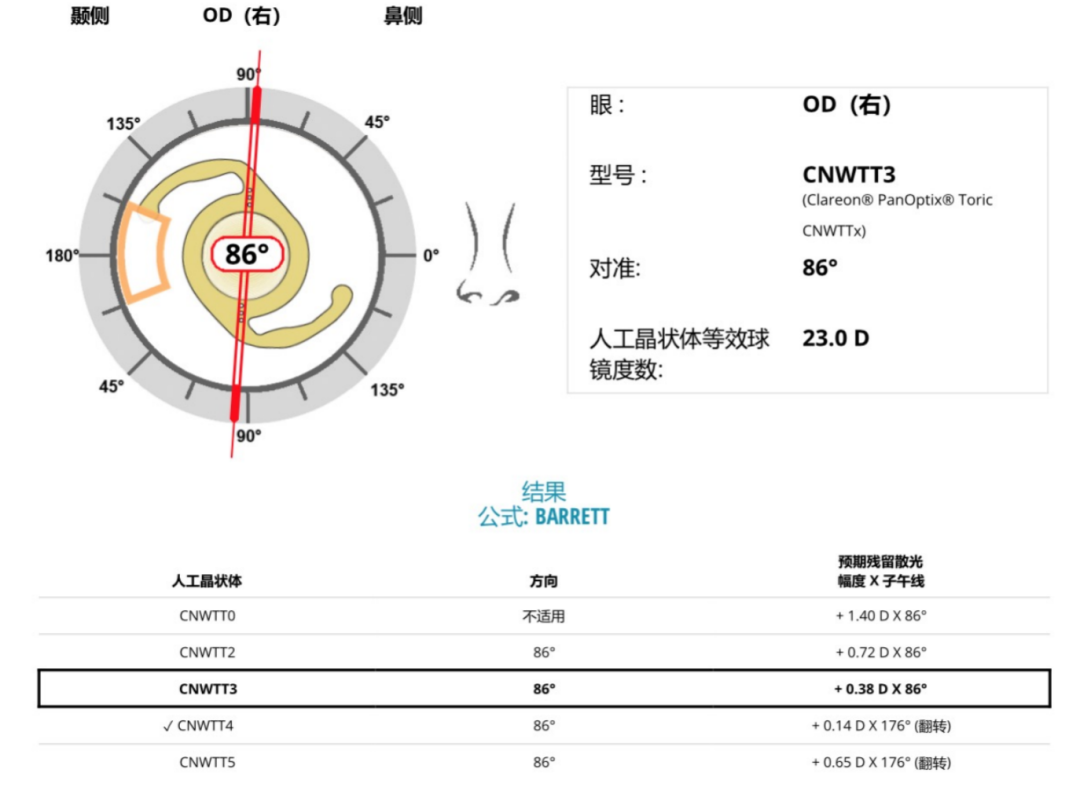 病例分享｜屈光白内障术后