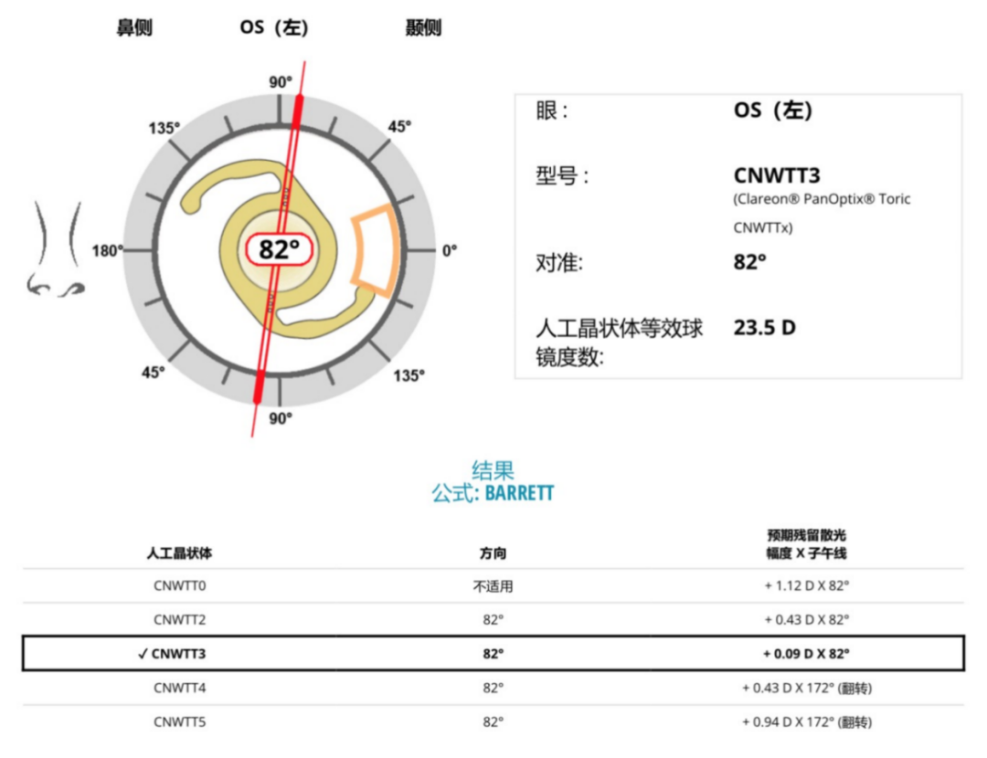 病例分享｜屈光白内障术后